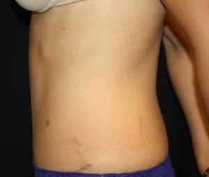 Tummy Tuck Before & After Patient #24602