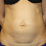 Tummy Tuck Before & After Patient #24602