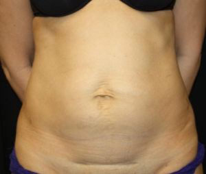 Tummy Tuck Before & After Patient #24602