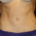 Tummy Tuck Before & After Patient #24602