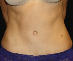 Tummy Tuck Before & After Patient #24602