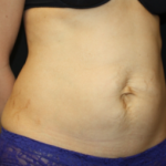 Tummy Tuck Before & After Patient #24602