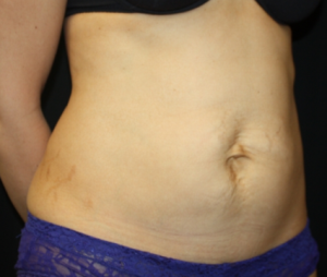 Tummy Tuck Before & After Patient #24602