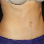 Tummy Tuck Before & After Patient #24602