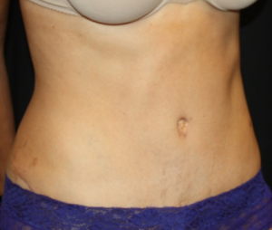 Tummy Tuck Before & After Patient #24602