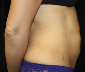 Tummy Tuck Before & After Patient #24602