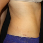 Tummy Tuck Before & After Patient #24602