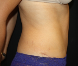 Tummy Tuck Before & After Patient #24602