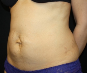 Tummy Tuck Before & After Patient #24602