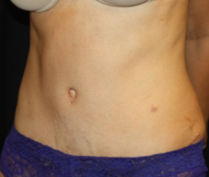 Tummy Tuck Before & After Patient #24602