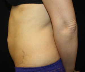 Tummy Tuck Before & After Patient #24602