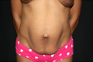 Tummy Tuck Before & After Patient #20008