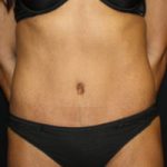 Tummy Tuck Before & After Patient #20008