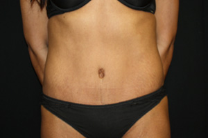 Tummy Tuck Before & After Patient #20008