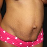 Tummy Tuck Before & After Patient #20008