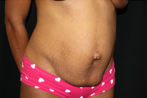 Tummy Tuck Before & After Patient #20008