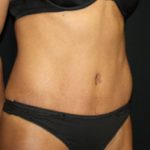 Tummy Tuck Before & After Patient #20008