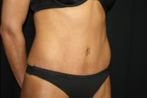 Tummy Tuck Before & After Patient #20008