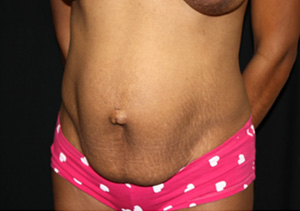 Tummy Tuck Before & After Patient #20008