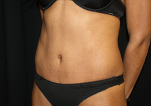 Tummy Tuck Before & After Patient #20008