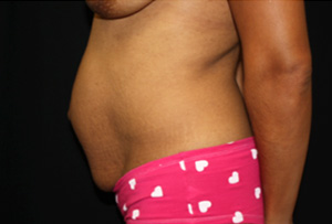 Tummy Tuck Before & After Patient #20008