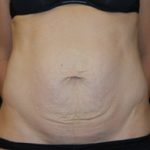 Tummy Tuck Before & After Patient #24603
