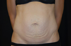 Tummy Tuck Before & After Patient #24603