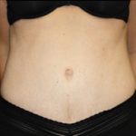 Tummy Tuck Before & After Patient #24603