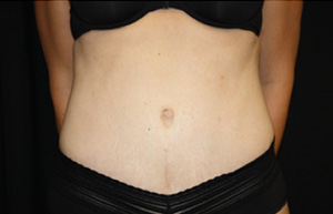 Tummy Tuck Before & After Patient #24603