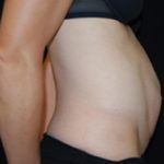 Tummy Tuck Before & After Patient #24603