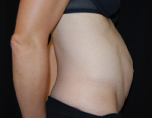 Tummy Tuck Before & After Patient #24603