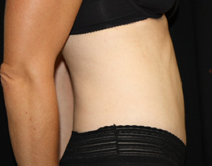 Tummy Tuck Before & After Patient #24603