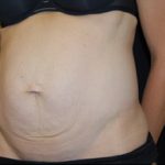 Tummy Tuck Before & After Patient #24603