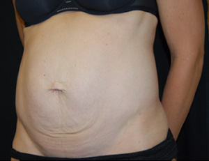 Tummy Tuck Before & After Patient #24603