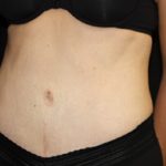 Tummy Tuck Before & After Patient #24603