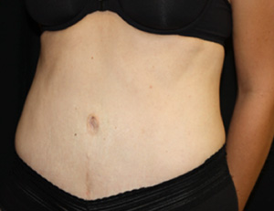 Tummy Tuck Before & After Patient #24603