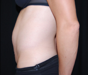 Tummy Tuck Before & After Patient #24603