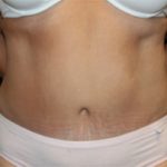 Tummy Tuck Before & After Patient #24622