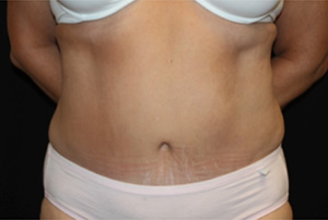 Tummy Tuck Before & After Patient #24622