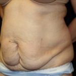 Tummy Tuck Before & After Patient #24622