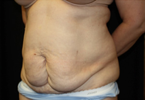 Tummy Tuck Before & After Patient #24622