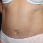 Tummy Tuck Before & After Patient #24622