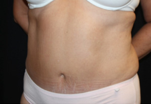 Tummy Tuck Before & After Patient #24622