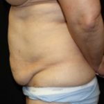 Tummy Tuck Before & After Patient #24622