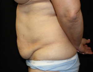 Tummy Tuck Before & After Patient #24622