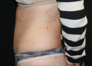 Tummy Tuck Before & After Patient #24625