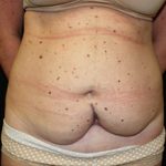 Tummy Tuck Before & After Patient #24625