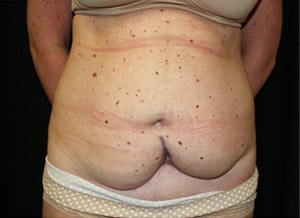 Tummy Tuck Before & After Patient #24625