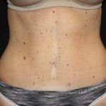 Tummy Tuck Before & After Patient #24625