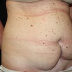 Tummy Tuck Before & After Patient #24625